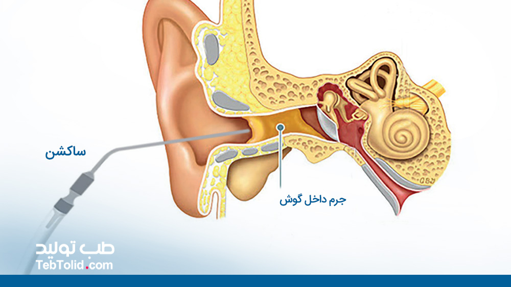 شستن جرم گوش