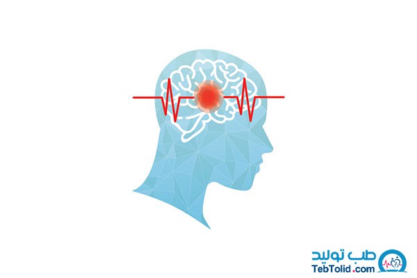 همه چیز درباره سکته مغزی خفیف یا TIA