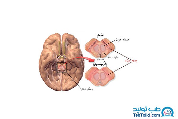 آشنایی با بیماری پارکینسون، علائم و روش های درمان آن