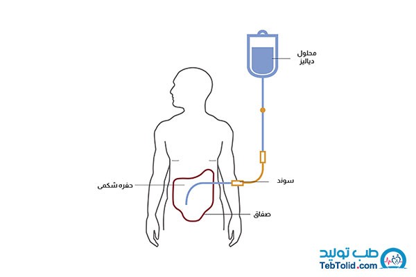دیالیز چیست؟ معرفی انواع روش های دیالیز